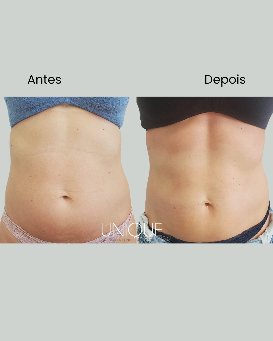 Antes e depois — redução de gordura abdominal (mulher, vista frontal)