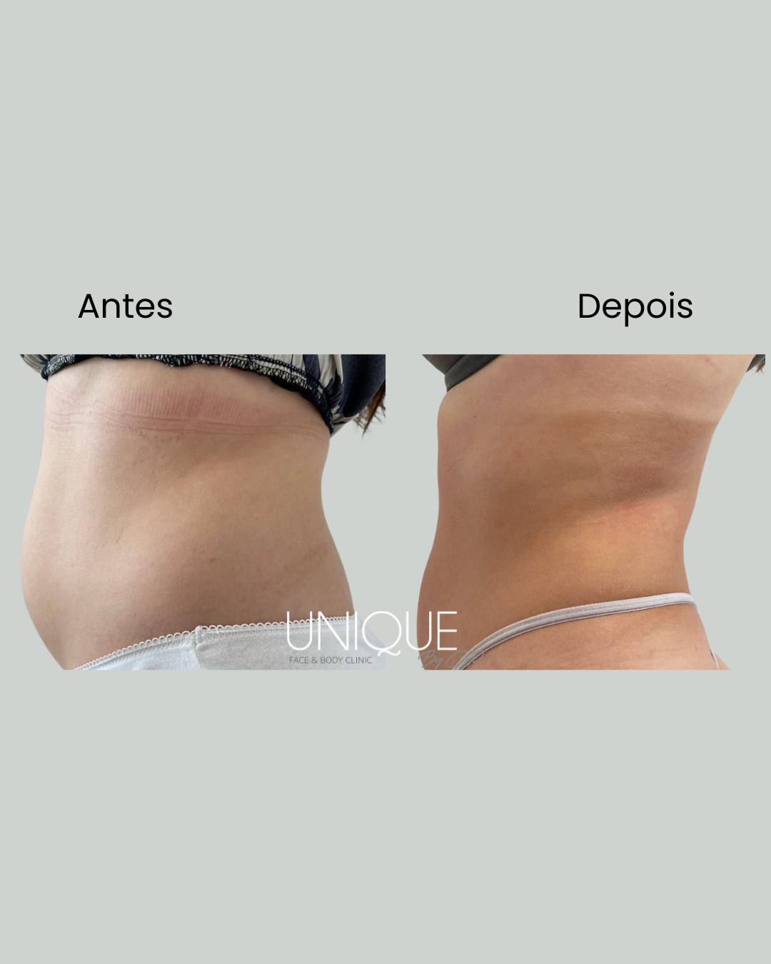 Antes e depois — contorno abdominal e do flanco (mulher)