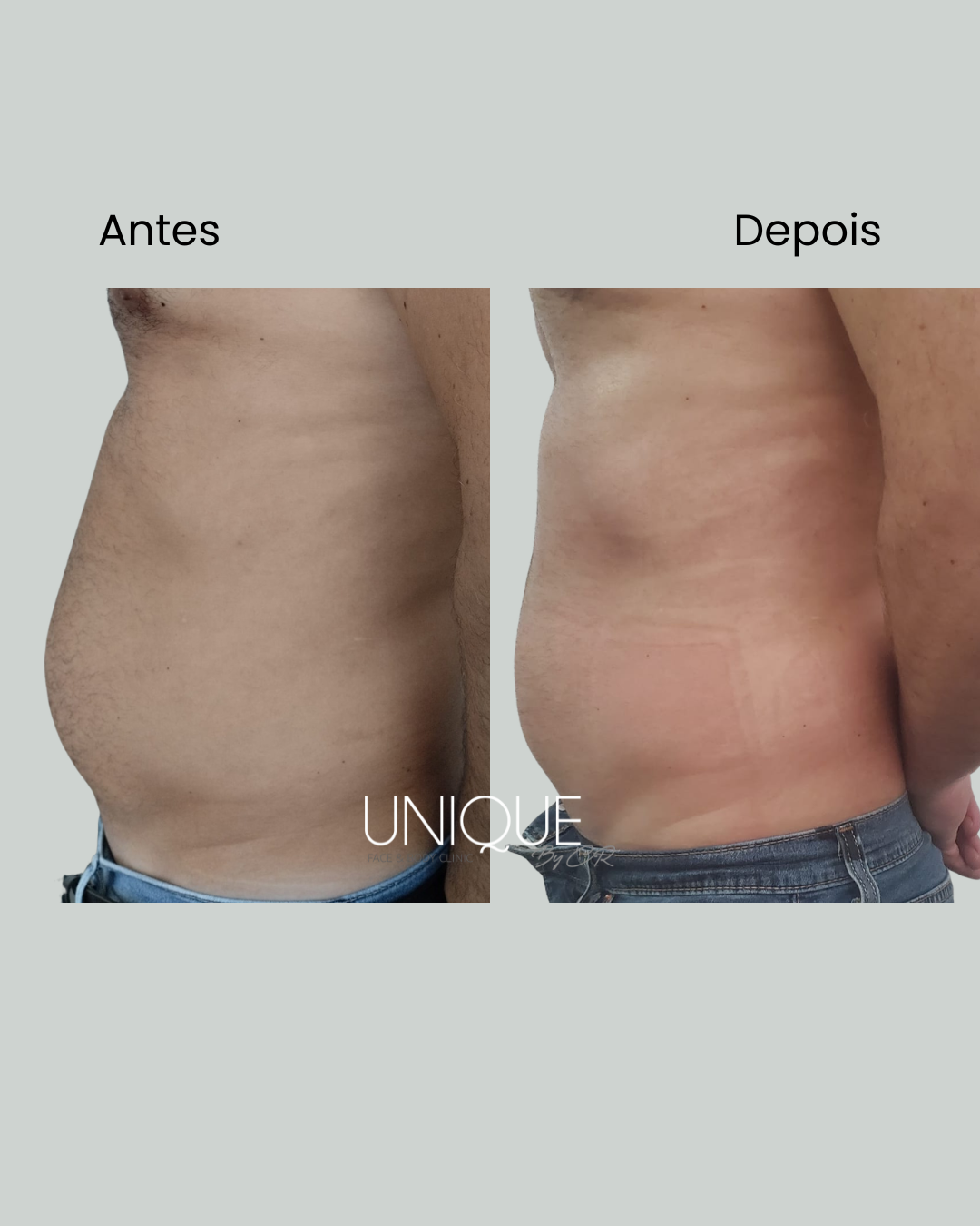 Antes e depois — redução de flancos (homem)