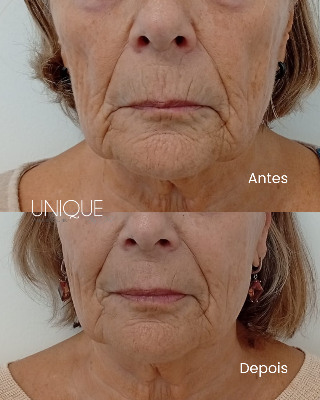 Antes e depois — suavização de rugas peribucais (vista frontal)
