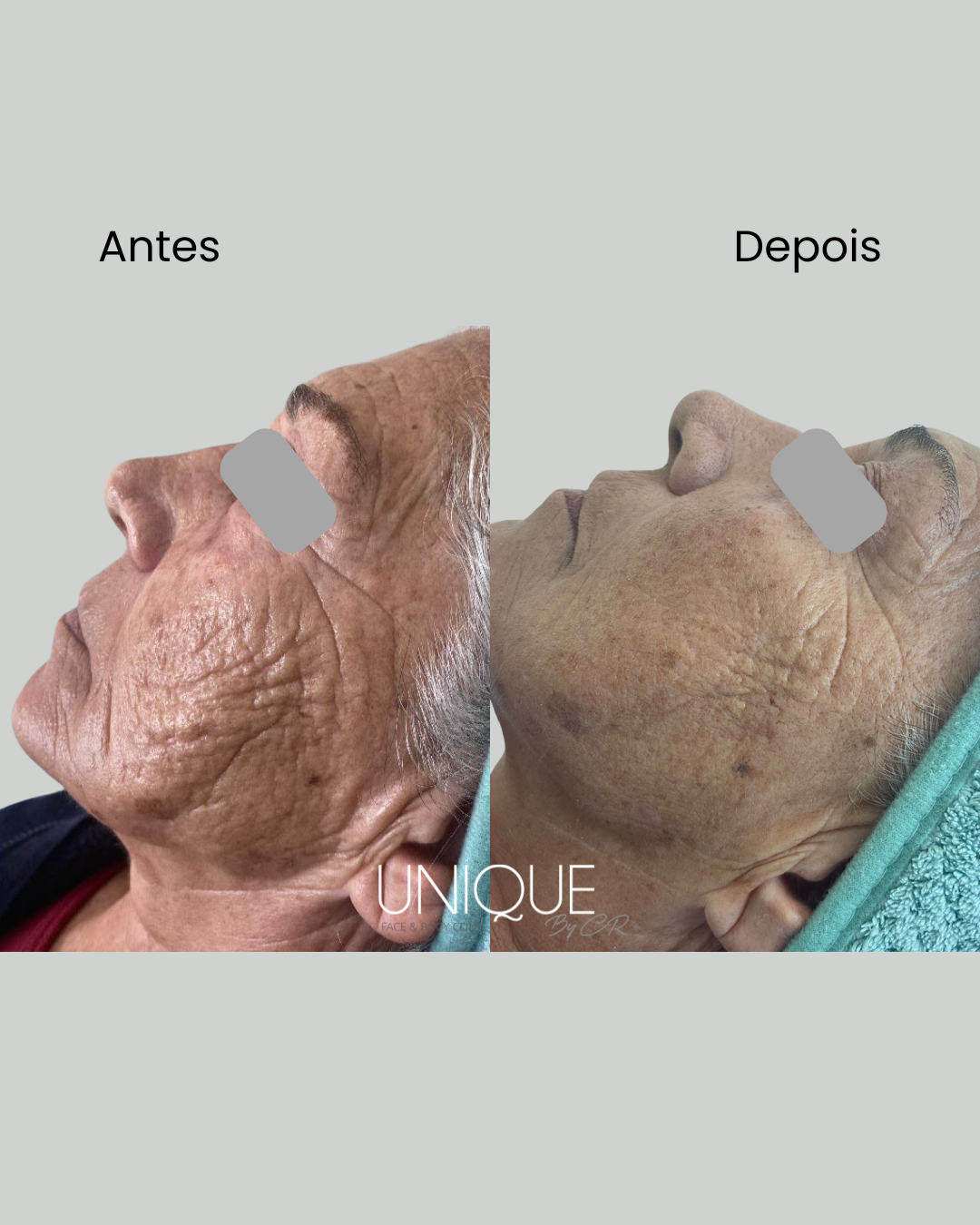 Antes e depois — qualidade da pele no pescoço e maxilar