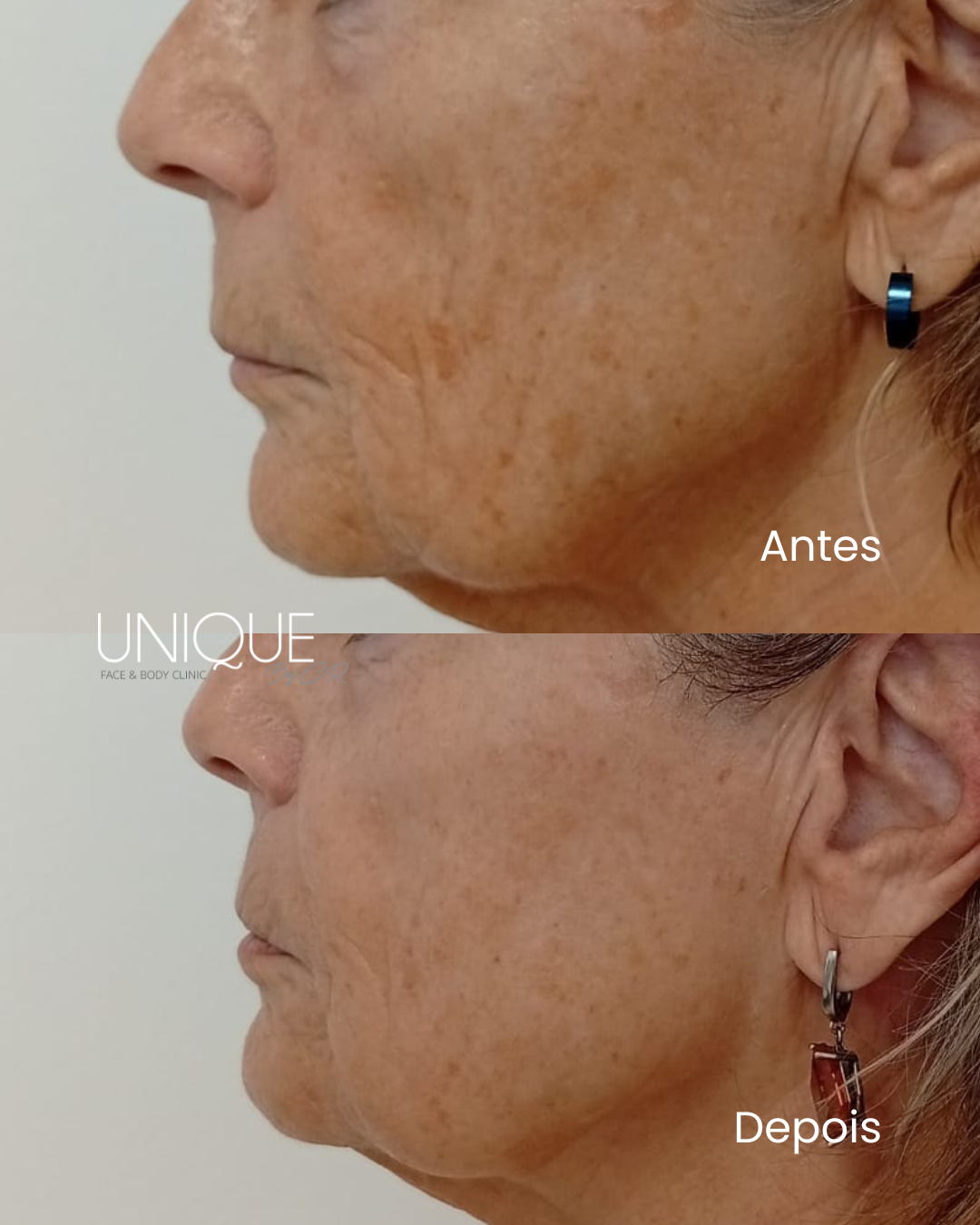 Antes e depois — atenuação de rugas e manchas (perfil)
