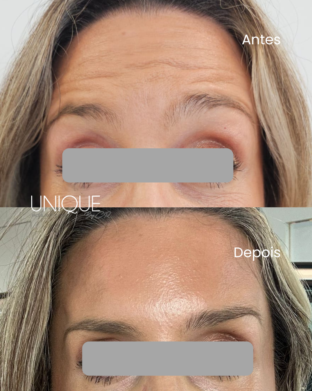 Antes e depois — suavização de rugas da testa (close-up)