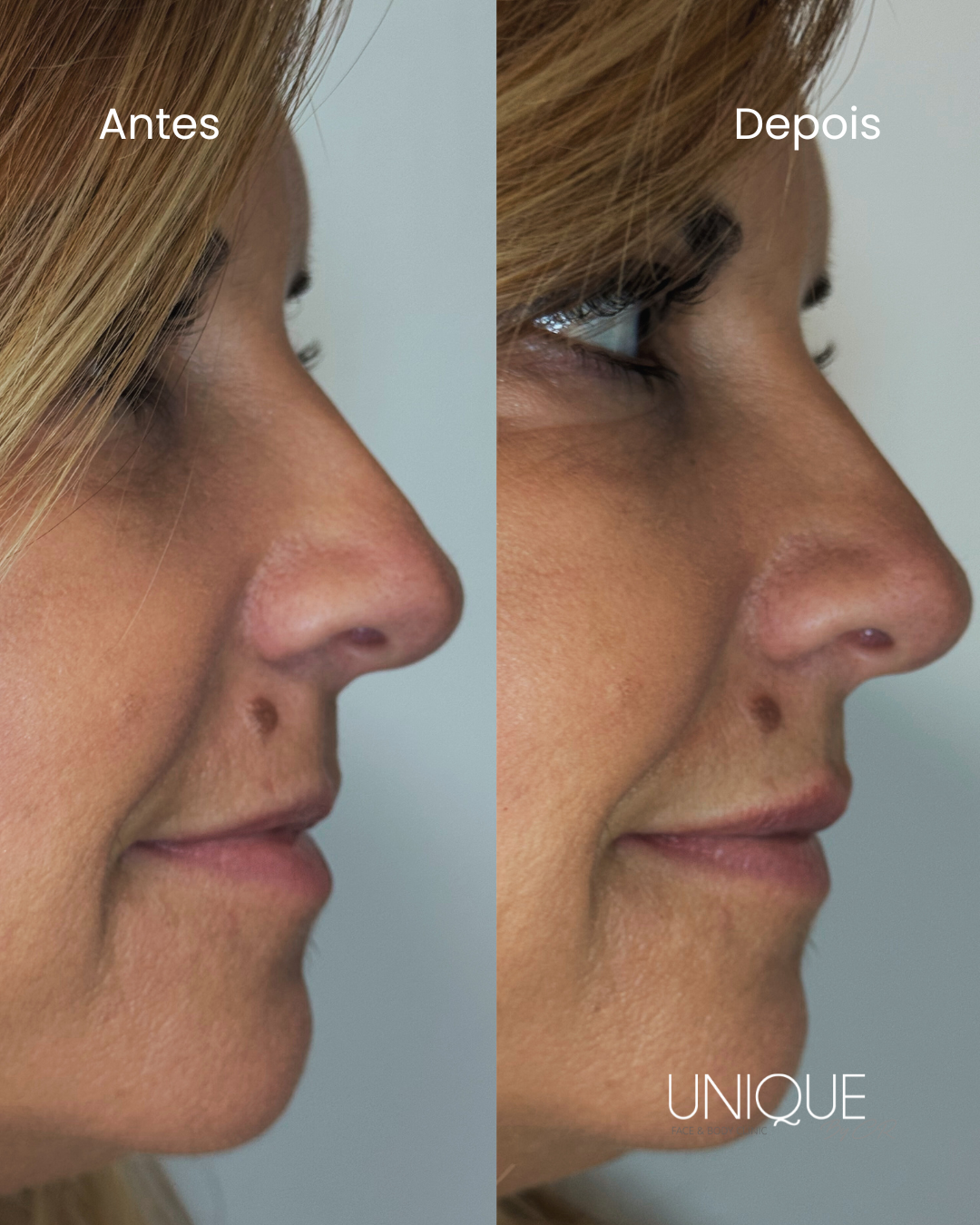 Antes e depois — rinomodelação com ácido hialurónico (perfil)