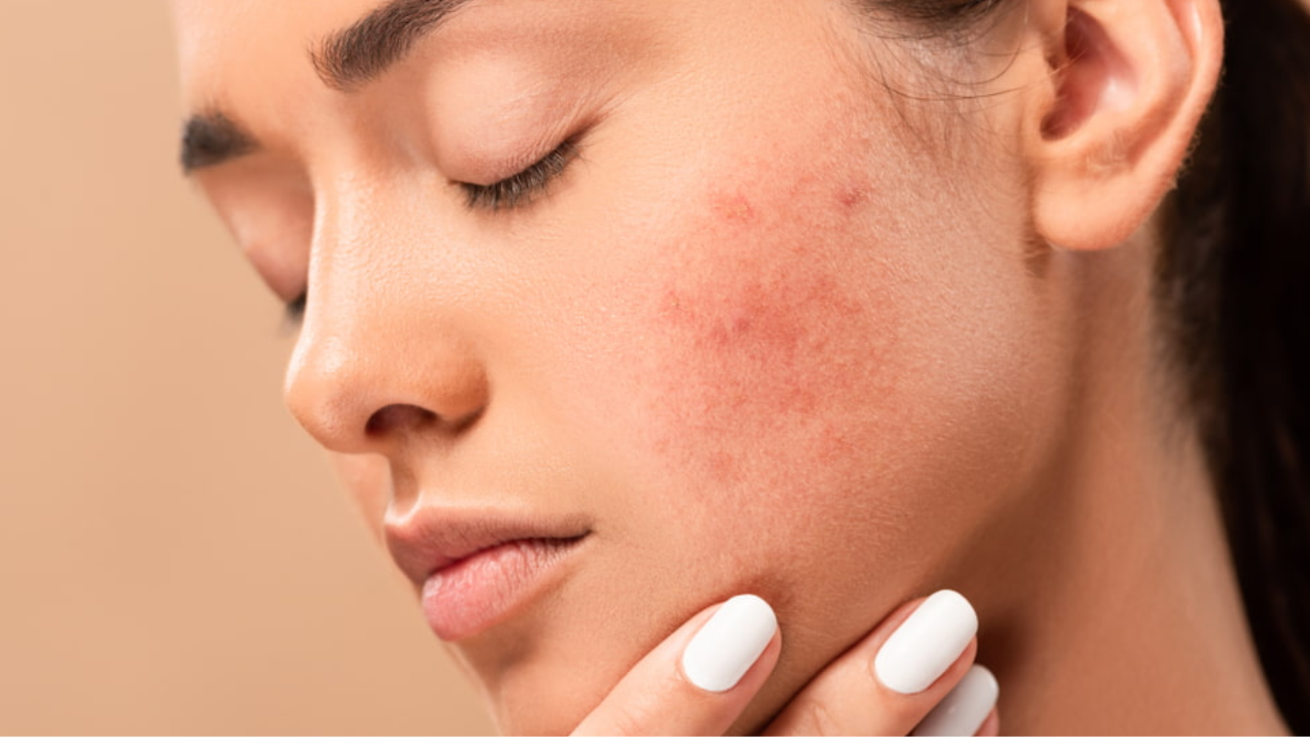 Skin Spots