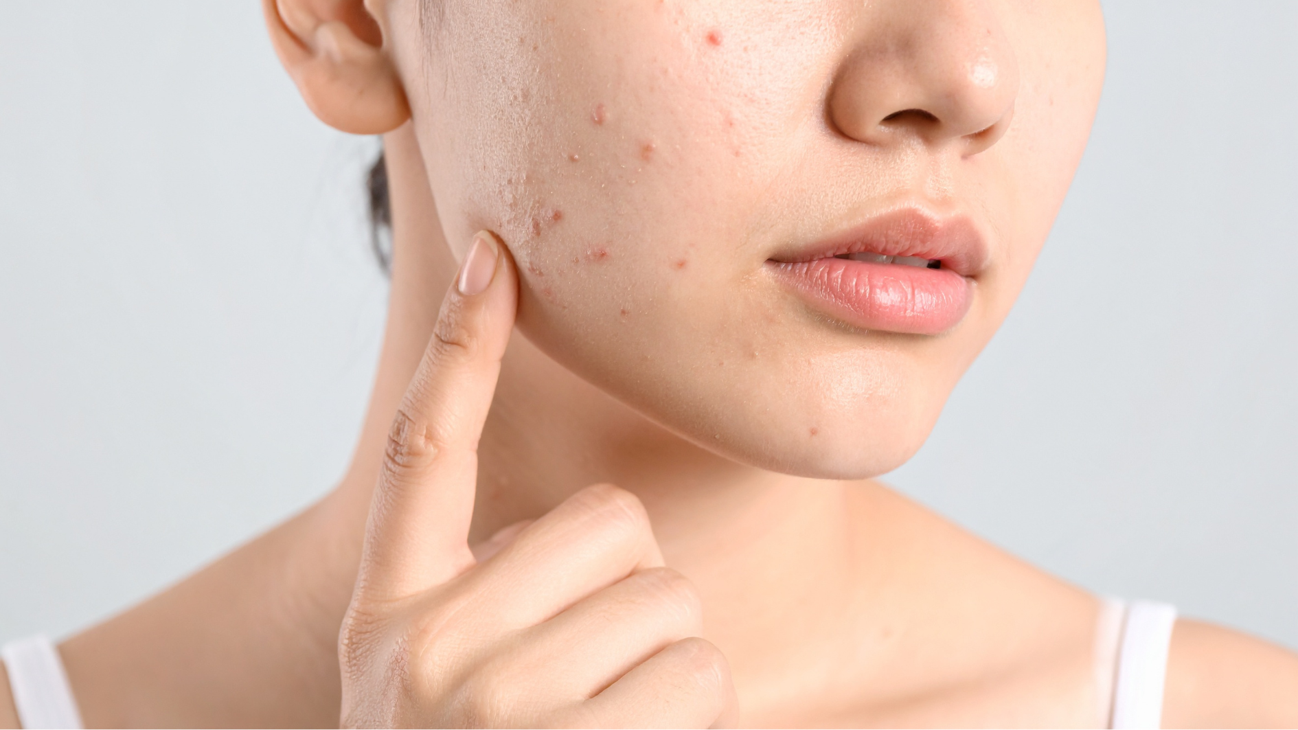 Acne Marks