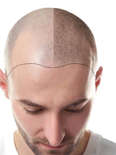 Micropigmentação Capilar?